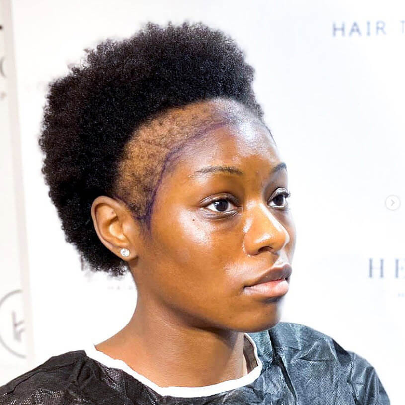 Afro-female-hair-loss-before-hair-transplant-1.jpg