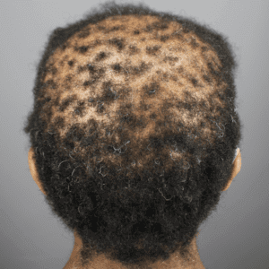 CCCA-Patient-Example-1-300x300-1.png