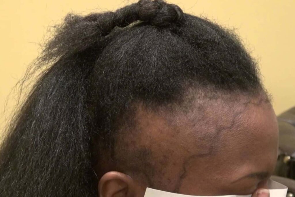 Hairline-treatment-1.jpg